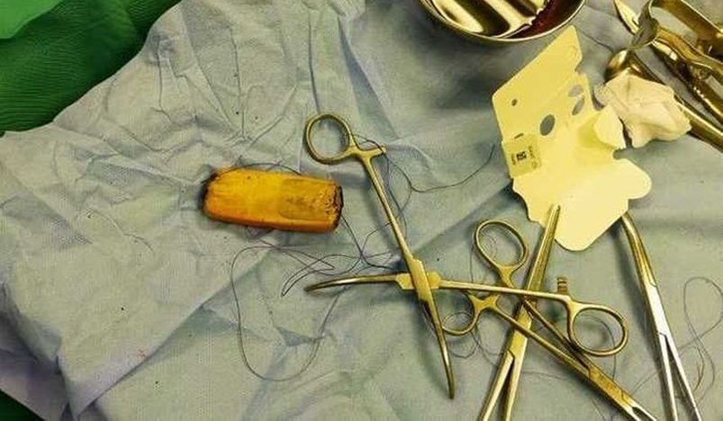 Doctors realized the patient had swallowed a small phone.